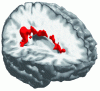 Figure 11 - 3D visualization with slice planes: segmentation result of multiple sclerosis lesions superimposed on the corresponding MRI image